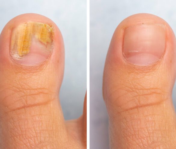 Fungal Nail Treatment - Laserlife Clinic London