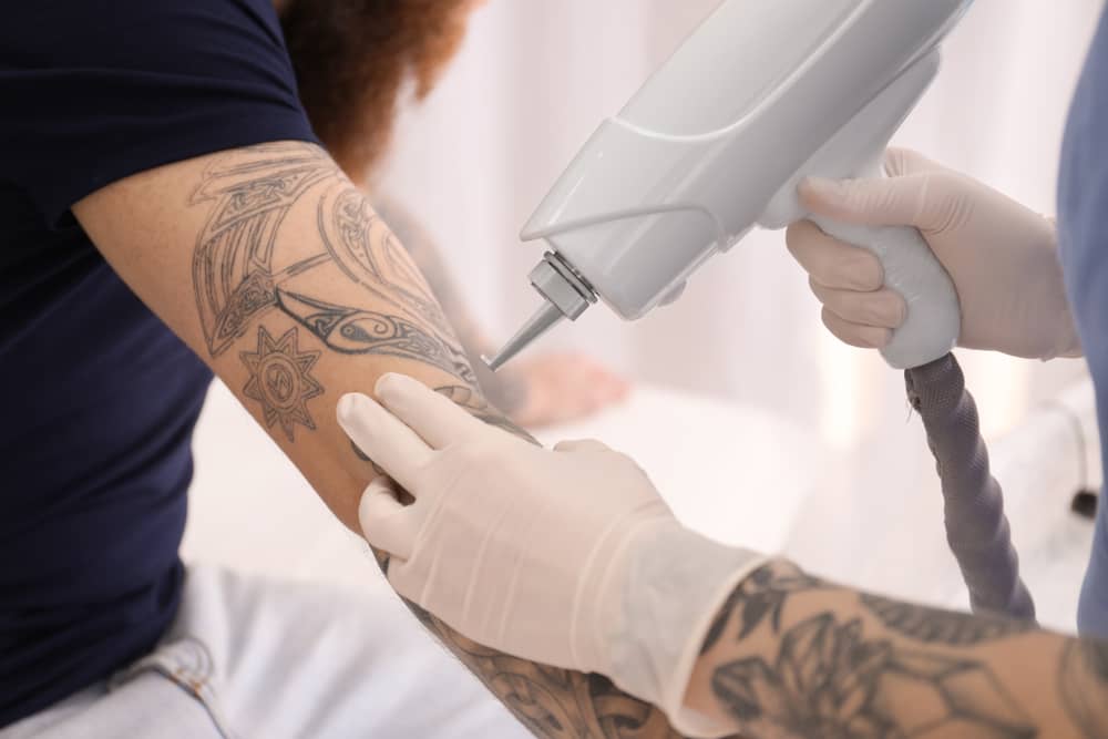 tattoo-removal-black-friday-offers