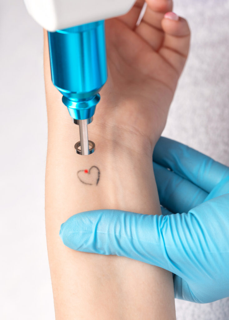 The doctor makes the procedure for laser tattoo removal on the girl's arm.