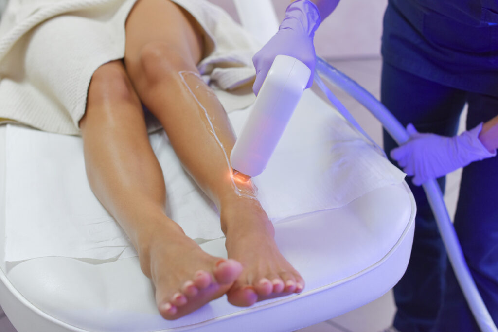 Hair removal with laser diod