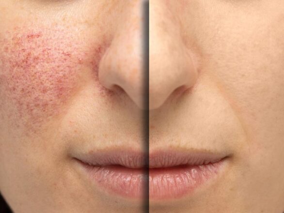 Rosacea-586x440-1-1.jpg