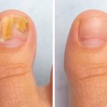 fungal-nail-585x494-1