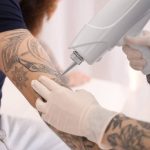 tattoo-removal-black-friday-offers